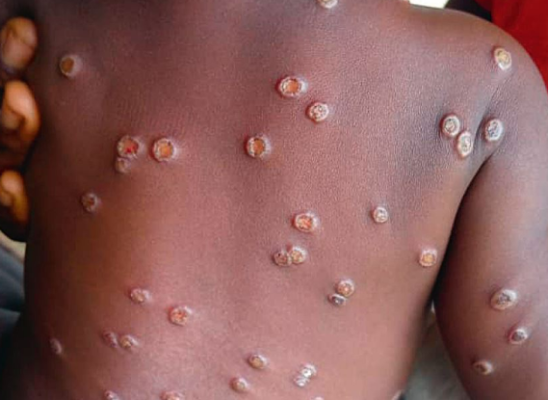 Contagion: Mpox lesions on an infected person can infect another