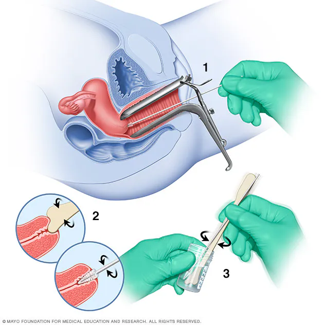 pap smear sample collection