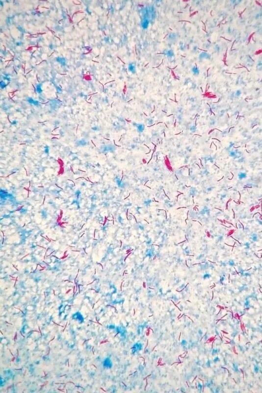 Ziehl-Neelsen stain, positive for Mycobacterium tuberculosis