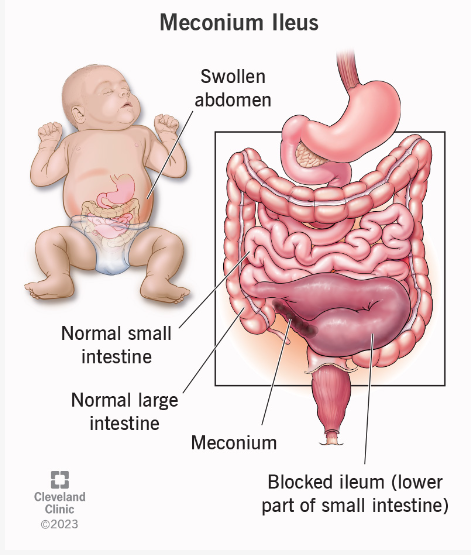 Meconium Ileus