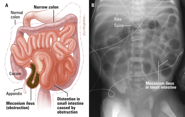 Meconium Ileus