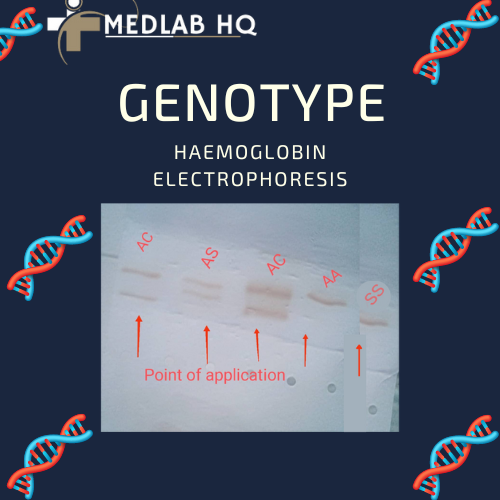 Haemoglobin Electrophoresis separation of AC, AA, AS, SS