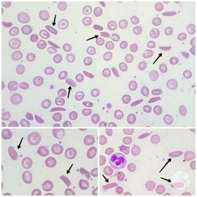 blood picture of crystalised red cells of Hb C