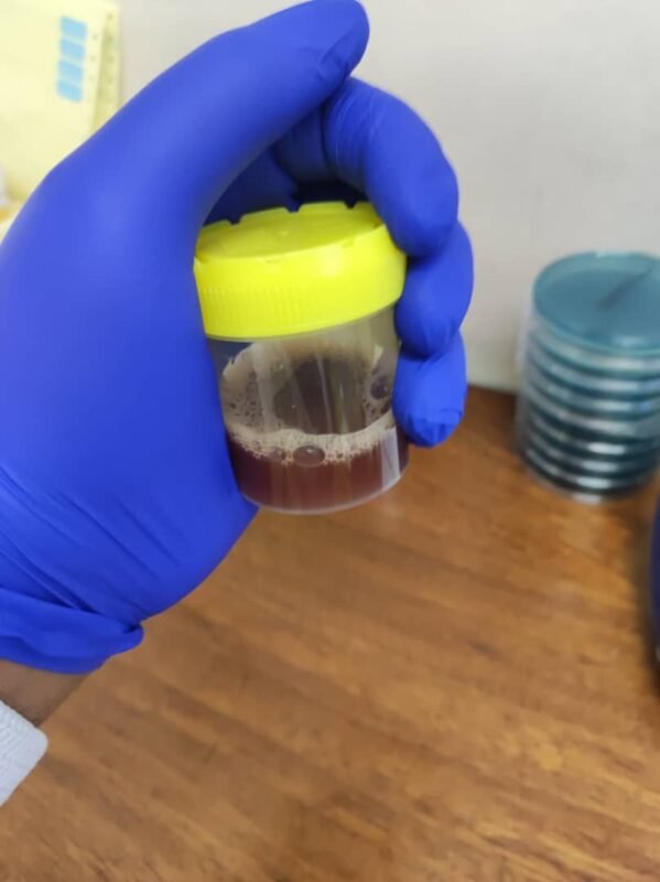 Blood in urine