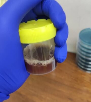 Blood in urine