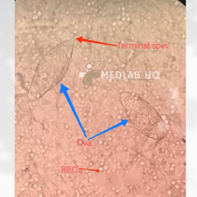 Slide of urine deposite containing Schistosoma haematobium ova and Red blood cells