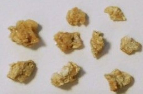 Kidney stones