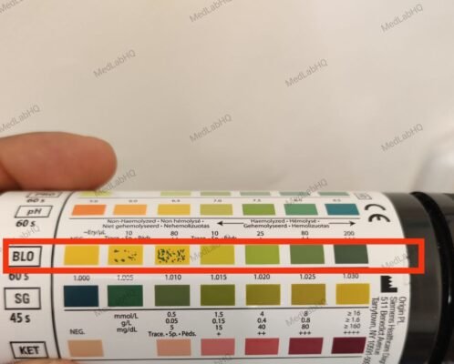 Blood in urine