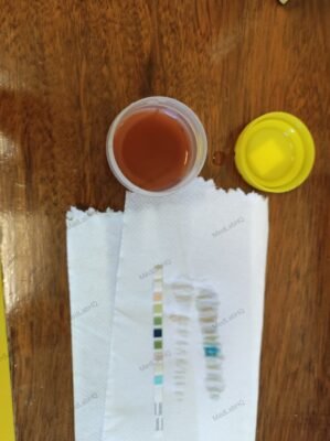 Blood in urine