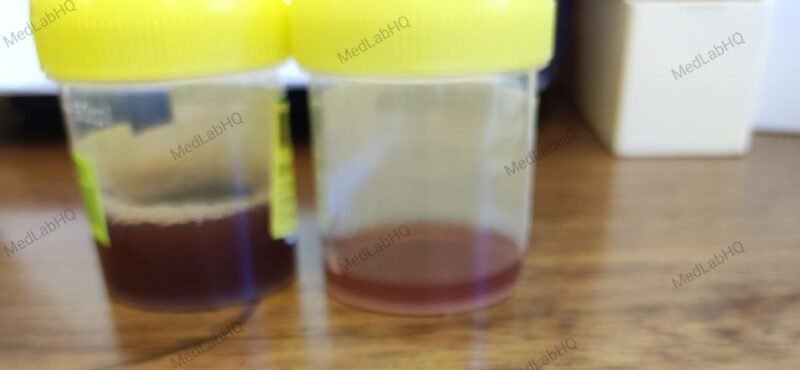 Blood in urine