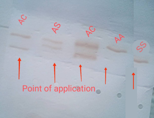 Haemoglobin Electrophoresis Migration of from left to right AC, AS, AC, AA, SS