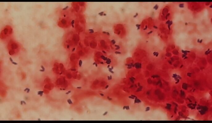 Corynebacterium diphtheriae Gram staining from sputum